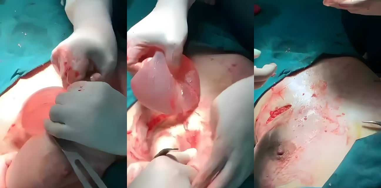 極品嫩模硅膠巨乳取出手術！昔日狂歡內幕曝光 血腥過程讓人心跳加速