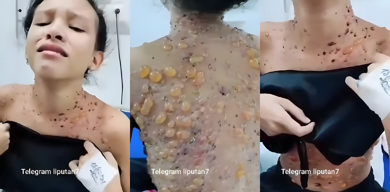 网友爆料猴痘感染超级大瓜！狂欢派对后甜美小妹全身溃烂 提醒大家注意防护
